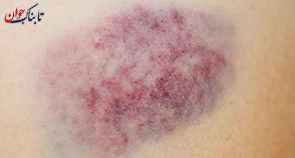 تروما بدن تروما یعنی چه و انواع آن در روانشناسی و پزشکی کدام است؟